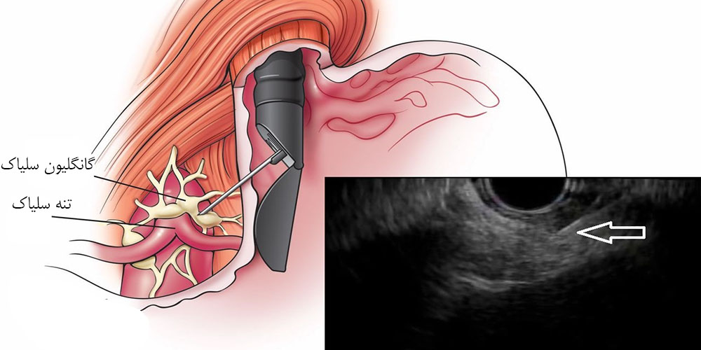 اندوسونوگرافی برای چیست 